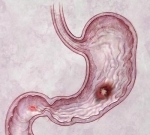 Cancerul gastric